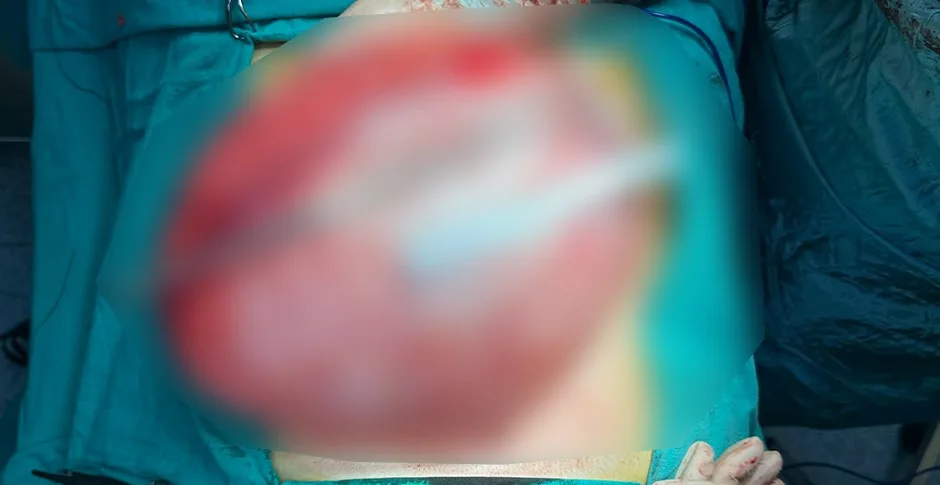 Bolu’da fazla kilolarından kurtulmak amacıyla hastaneye başvuran 14 yaşındaki lise
