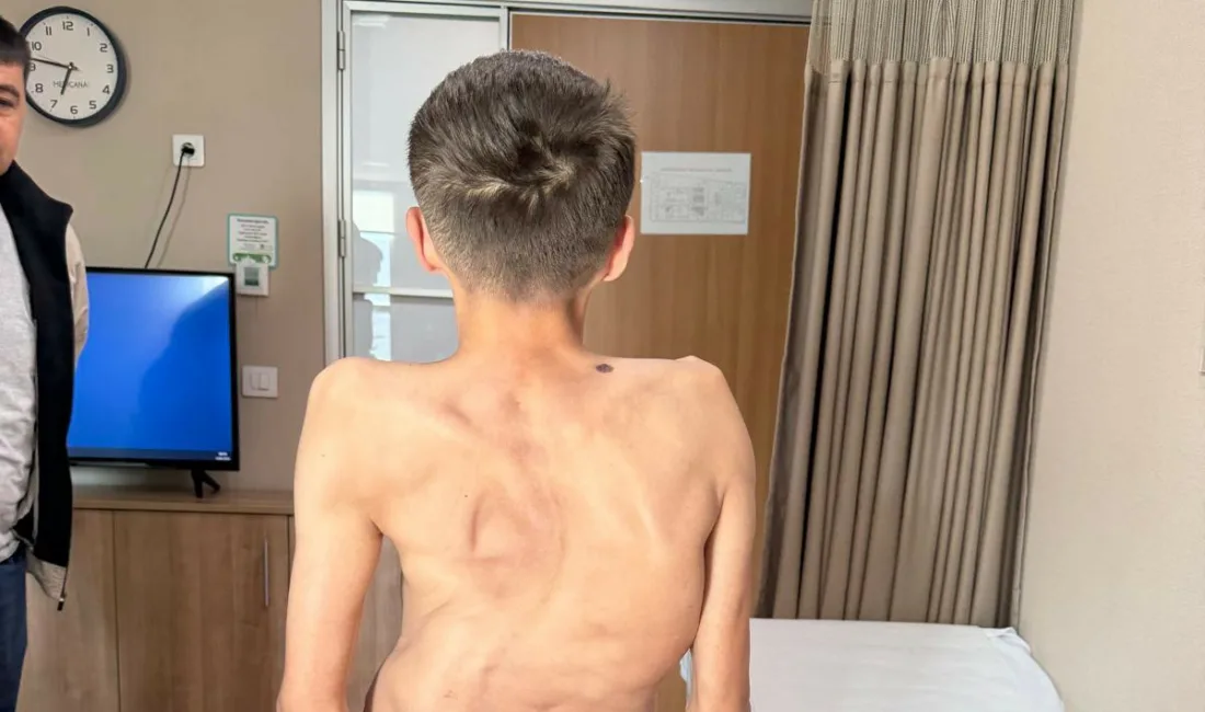 Kırgızistan’da 18 yaşına kadar skolyozla mücadele eden genç, Medicana Hastanesi’nde
