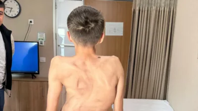 Kırgızistan’da 18 yaşına kadar skolyozla mücadele eden genç, Medicana Hastanesi’nde